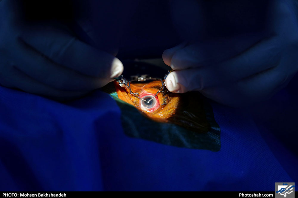 عمل جراحی سنتو لیزر در بیمارستان بینا