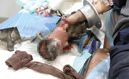 چرخ&zwnj;گوشت&zwnj;ها همچنان دست&zwnj;ها را می&zwnj;بلعند