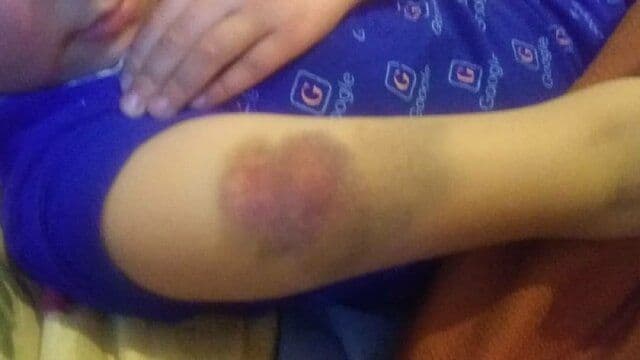 تنبیه بدنی دانش آموز قزوینی توسط معلم خشن + تصاویر دردناک