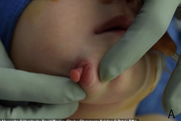 نوزادی با دو دهان متولد شد/ جراحی موفقیت آمیز دهان اضافه