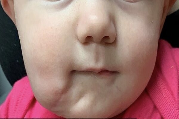 نوزادی با دو دهان متولد شد/ جراحی موفقیت آمیز دهان اضافه