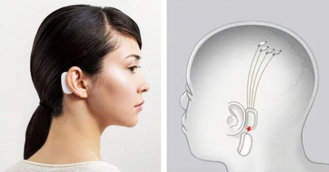 تراشه&zwnj;ای که می&zwnj;تواند درون مغز انسان، موسیقی پخش کند