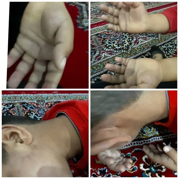 تنبیه وحشتناک دانشآموز کلاس اولی توسط معلمش در ایلام + تصاویر تنبیه وحشتناک دانشآموز کلاس اولی توسط معلمش در ایلام + تصاویر