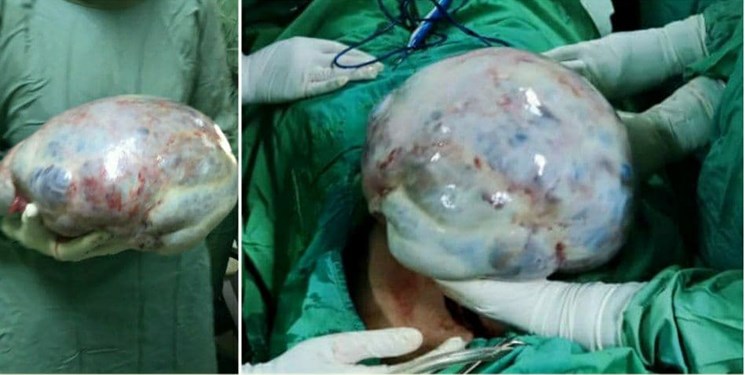 توده ۸ کیلویی از شکم بیمار اردبیلی خارج شد + عکس توده ۸ کیلویی از شکم بیمار اردبیلی خارج شد + عکس