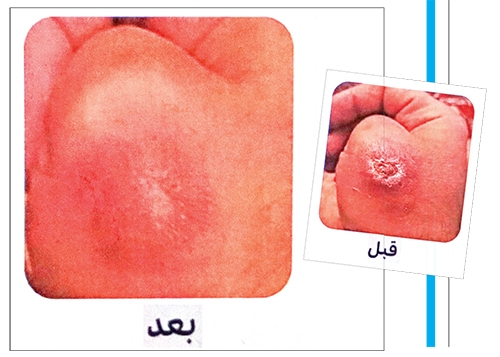 درمان قطعی سالک معطل کمکهای مالی درمان قطعی سالک معطل کمکهای مالی