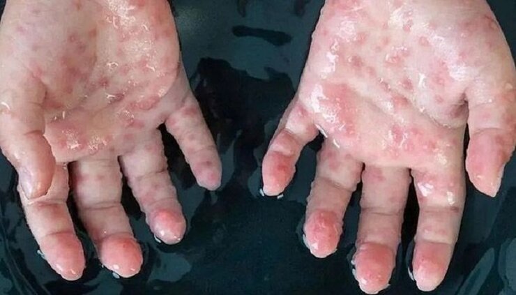 سازمان دامپزشکی: موردی از ابتلا به آبله میمون در ایران گزارش نشده است