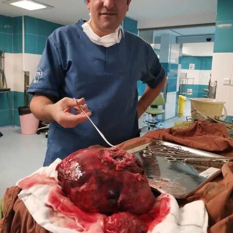 توده ۲۰ سانتیمتری از ریه بیمار ۲۴ ساله یزدی خارج شد توده ۲۰ سانتیمتری از ریه بیمار ۲۴ ساله یزدی خارج شد