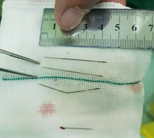 خارج کردن ۴ سوزن خیاطی از قلب و قفسه سینه زنی در اردبیل خارج کردن ۴ سوزن خیاطی از قلب و قفسه سینه زنی در اردبیل