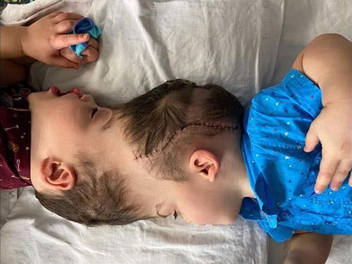 دوقلوهای به هم چسبیده برزیلی جدا شدند + عکس دوقلوهای به هم چسبیده برزیلی جدا شدند + عکس