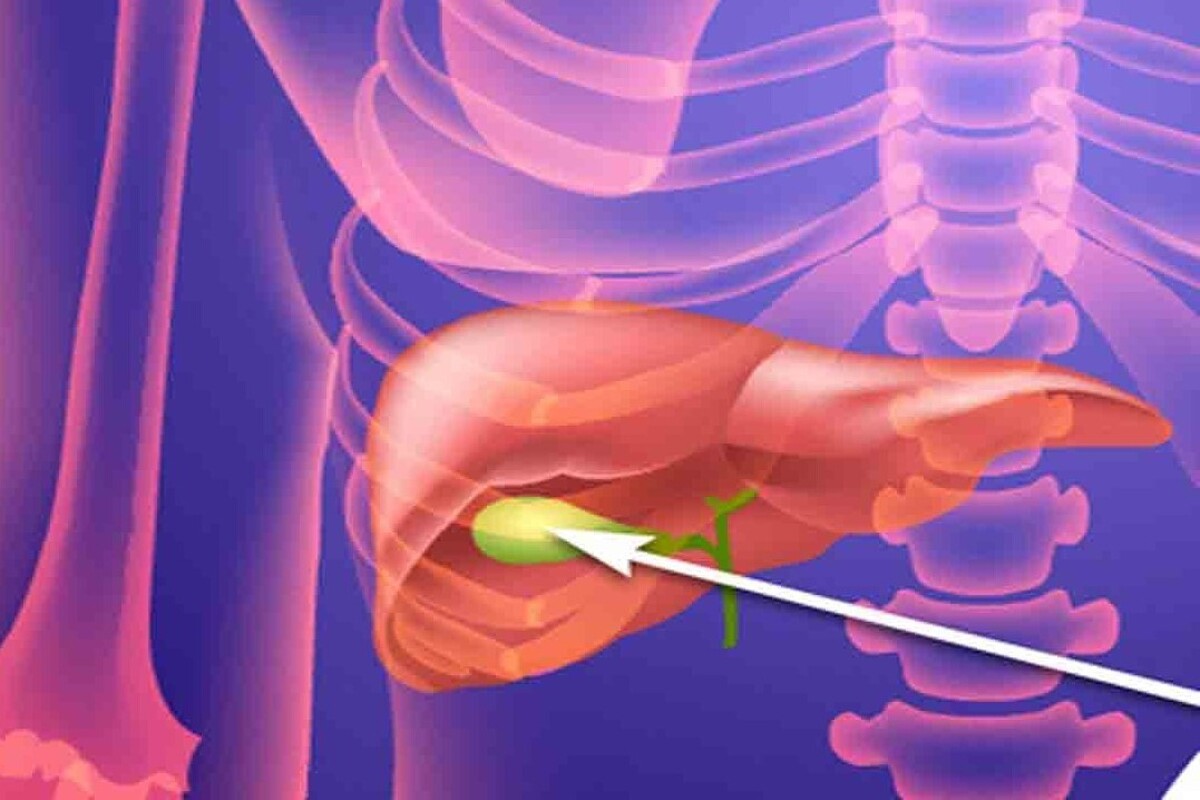 همه چیز درباره سنگ کیسه صفرا