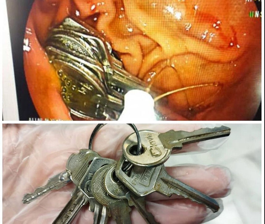 خروج دسته کلید از معده فرد نیشابوری + عکس خروج دسته کلید از معده فرد نیشابوری + عکس