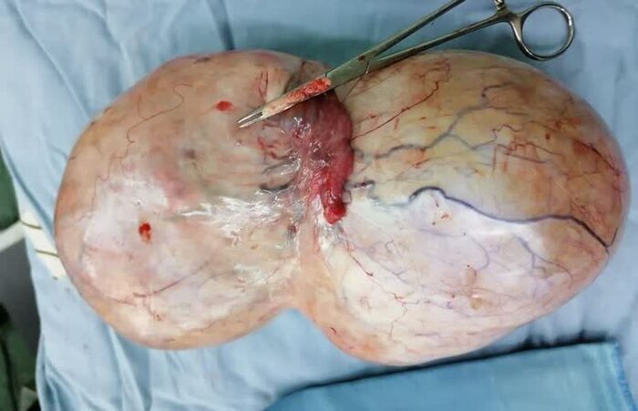 خروج یک توده ۲ کیلو و ۶۰۰ گرمی از بدن یک بیمار سبزواری + عکس (۱۹ اسفند ۱۴۰۲) خروج یک توده ۲ کیلو و ۶۰۰ گرمی از بدن یک بیمار سبزواری + عکس (۱۹ اسفند ۱۴۰۲)