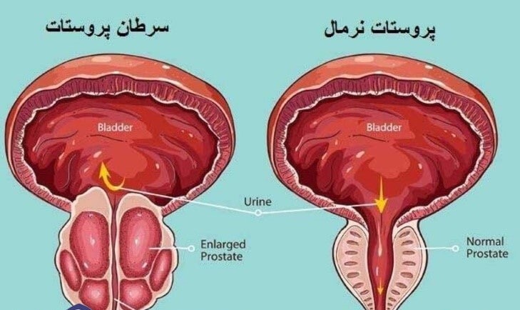 سرطان پروستات دومین سرطان شایع مردان ایرانی| روش‌های پیشگیری از سرطان پروستات چیست؟