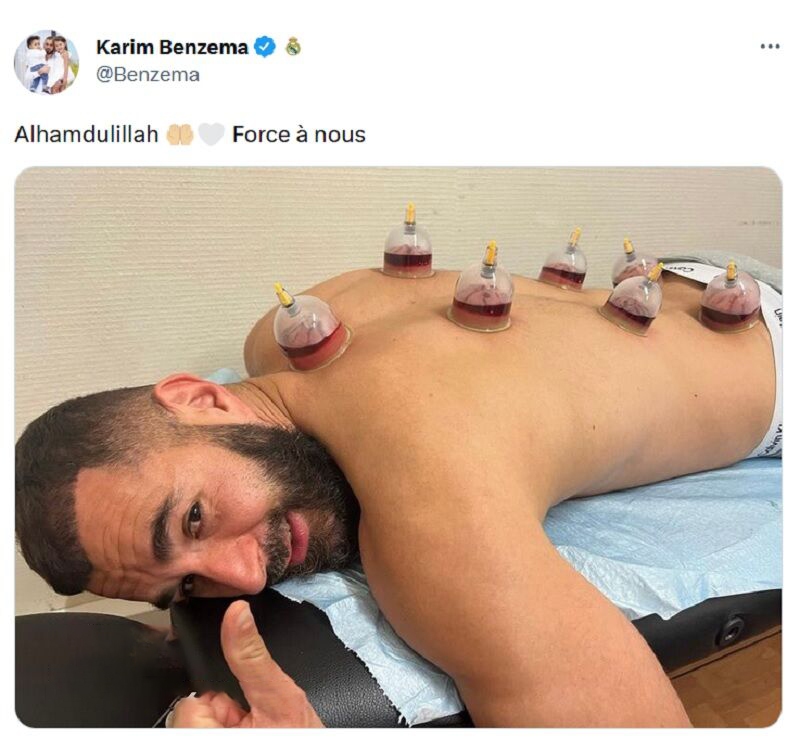 بنزما زیر تیغ حجامت + عکس بنزما زیر تیغ حجامت + عکس