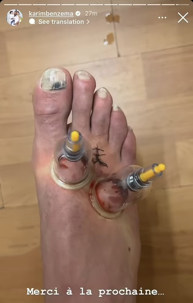 بنزما زیر تیغ حجامت + عکس بنزما زیر تیغ حجامت + عکس