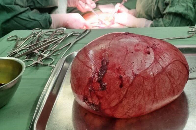 کیست چهارکیلویی در شکم یک دختر اسفراینی خارج شد +عکس کیست چهارکیلویی در شکم یک دختر اسفراینی خارج شد +عکس