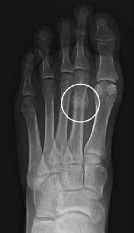 پای هافبک رئال مادرید شکست! + عکس پای هافبک رئال مادرید شکست! + عکس