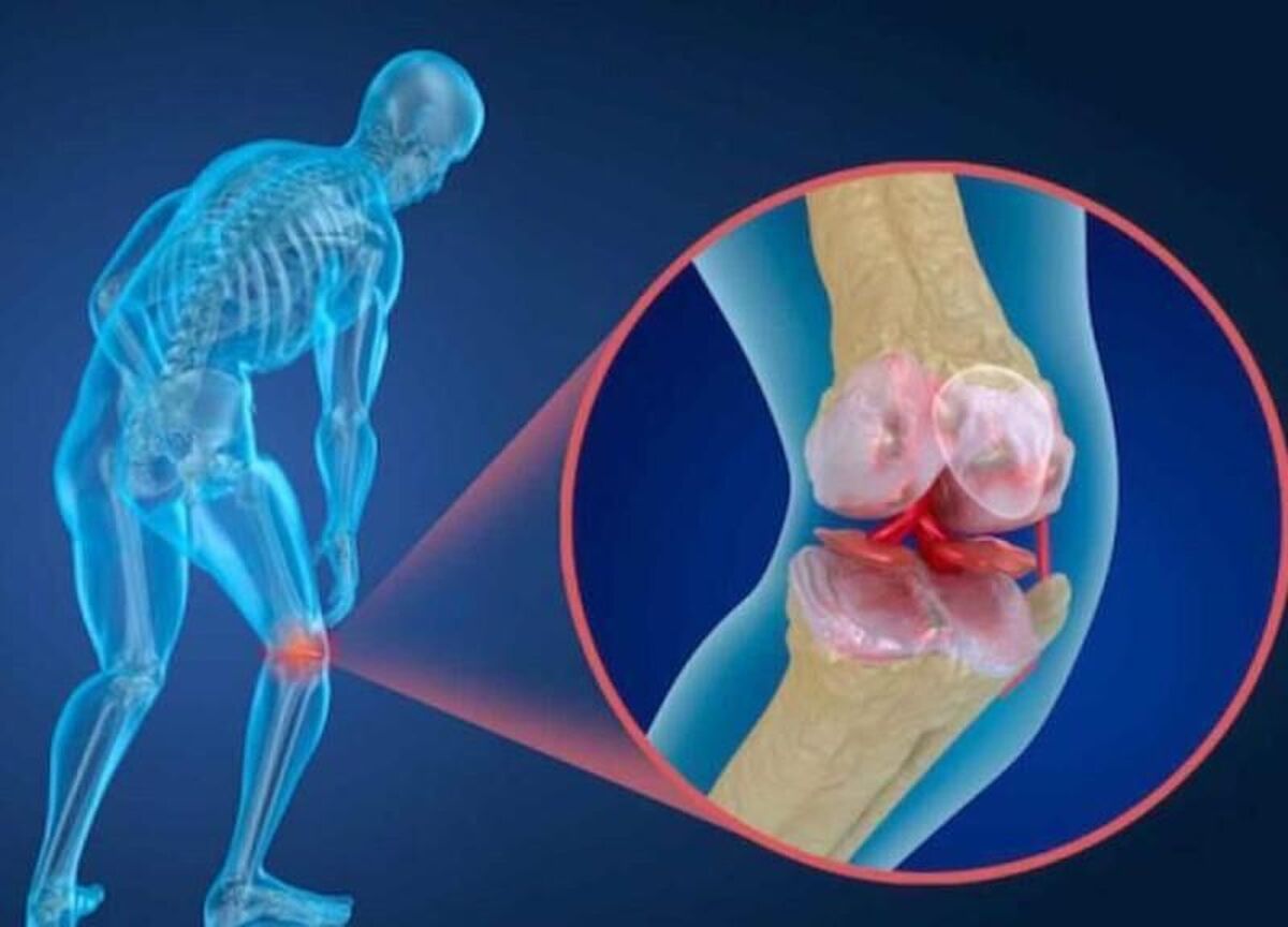 آیا جوان‌ها هم پوکی استخوان می‌گیرند؟