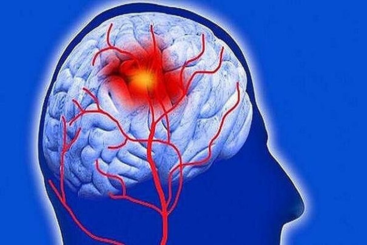 سکته مغزی، اولین علت ناتوانی در کشور