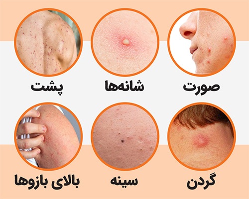 چاله‌چوله‌های پوستی