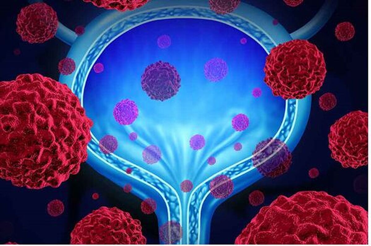مهم‌ترین علامت سرطان پروستات تغییر شرایط ادراری است