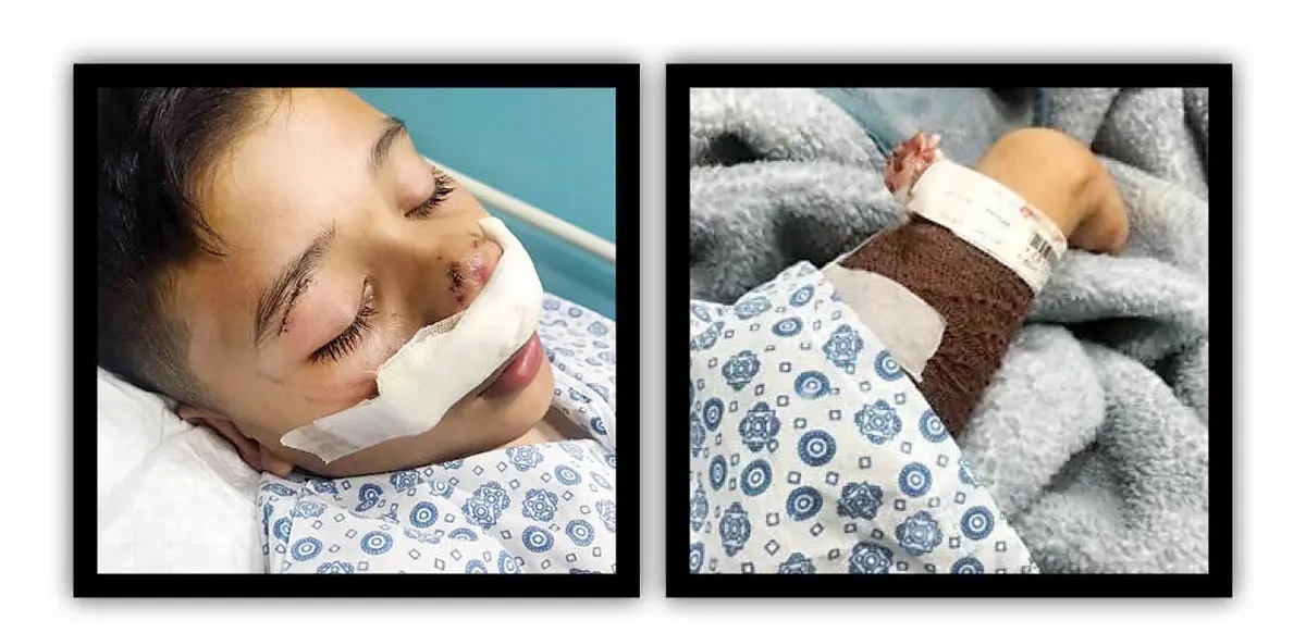 جدال وحشتناک پسربچه ۱۲ ساله و سگ ولگرد در کرج + عکس جدال وحشتناک پسربچه ۱۲ ساله و سگ ولگرد در کرج + عکس