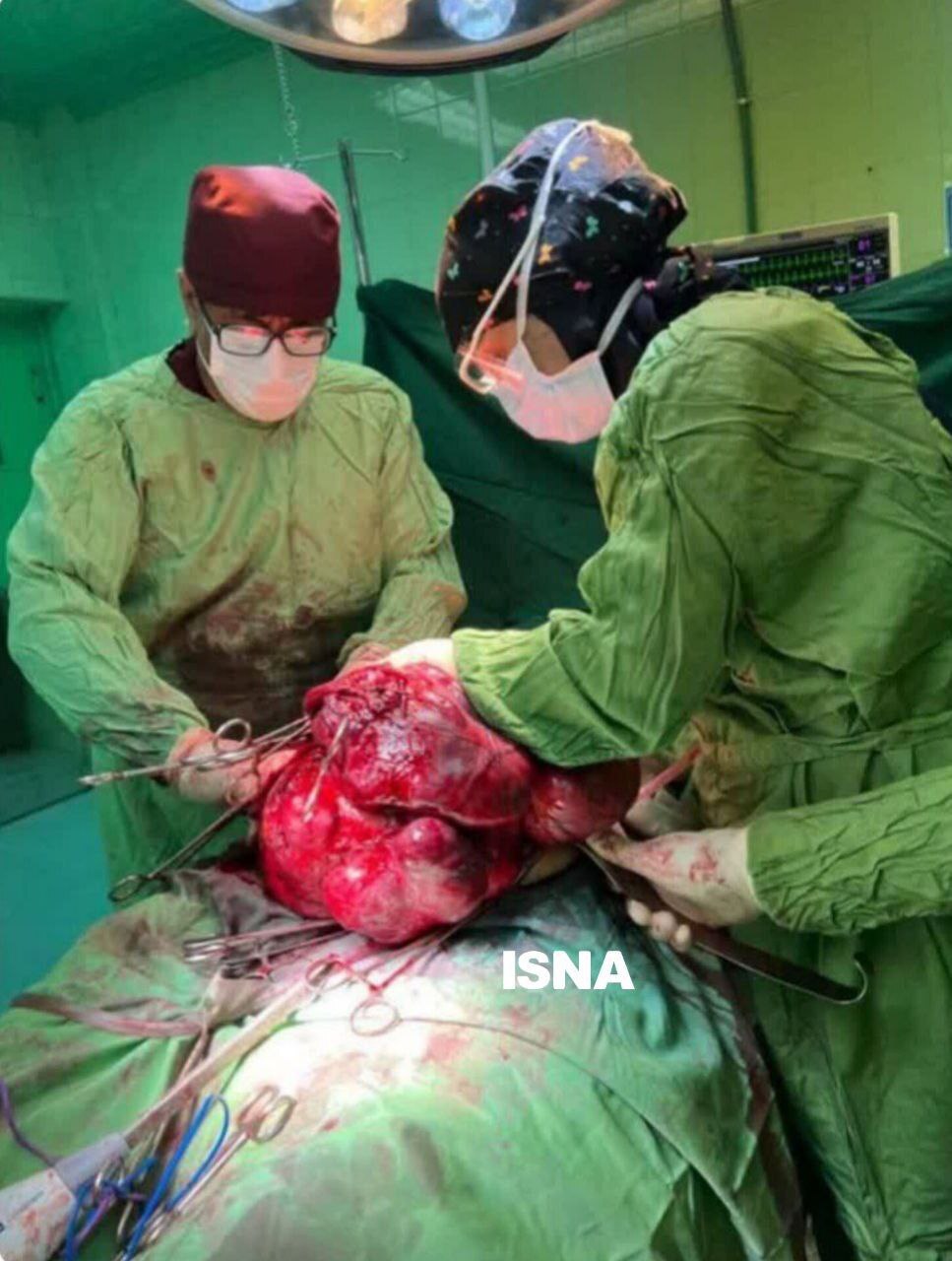 خارج کردن تومور ۱۱ کیلویی از شکم بیمار در استان فارس + عکس خارج کردن تومور ۱۱ کیلویی از شکم بیمار در استان فارس + عکس