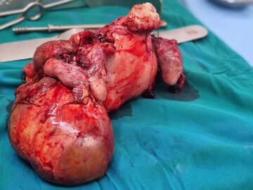 تومور ۱۶ کیلویی از شکم یک بیمار در مشهد خارج شد (۱۸ تیر ۱۴۰۳) تومور ۱۶ کیلویی از شکم یک بیمار در مشهد خارج شد (۱۸ تیر ۱۴۰۳)