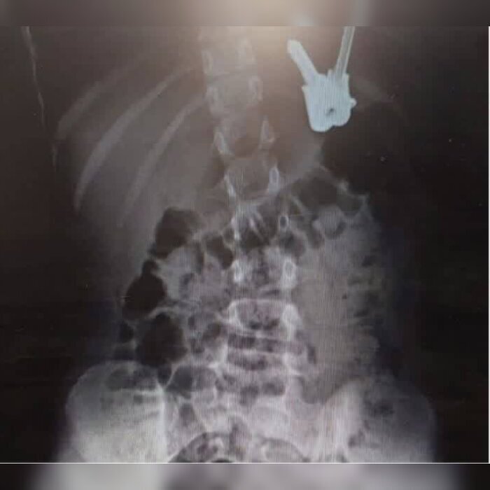 پیدا شدن دسته کلید در شکم کودک ۶ ساله سبزواری (۱۴ شهریور ۱۴۰۳) پیدا شدن دسته کلید در شکم کودک ۶ ساله سبزواری (۱۴ شهریور ۱۴۰۳)