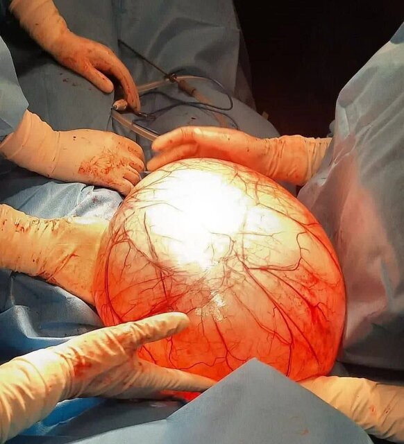 خارج کردن توده ۱۰ کیلویی از شکم زن جوان کرمانشاهی (۴ مهر ۱۴۰۳) خارج کردن توده ۱۰ کیلویی از شکم زن جوان کرمانشاهی (۴ مهر ۱۴۰۳)