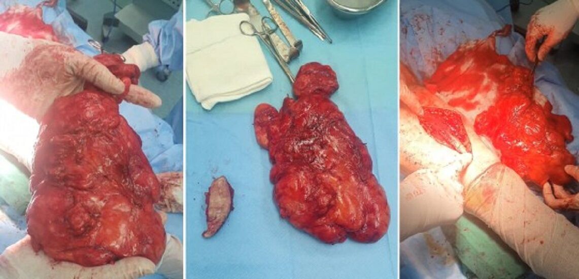 خارج کردن یک توده ۲ کیلوگرمی از پای بیماری در گناباد (۷ مهر ۱۴۰۳) خارج کردن یک توده ۲ کیلوگرمی از پای بیماری در گناباد (۷ مهر ۱۴۰۳)