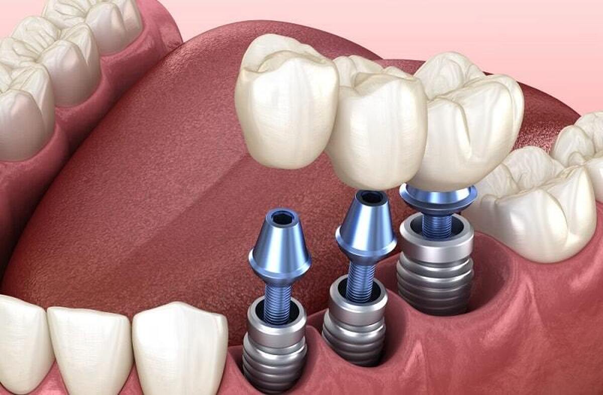 متخصص رادیولوژی و عضو هیات علمی دانشگاه علوم پزشکی کردستان گفت: اهمیت تصویربرداری در فرآیند درمان دندانپزشکی به ویژه در زمینه طراحی و قرار دادن ایمپلنت‌ها بسیار مهم است.