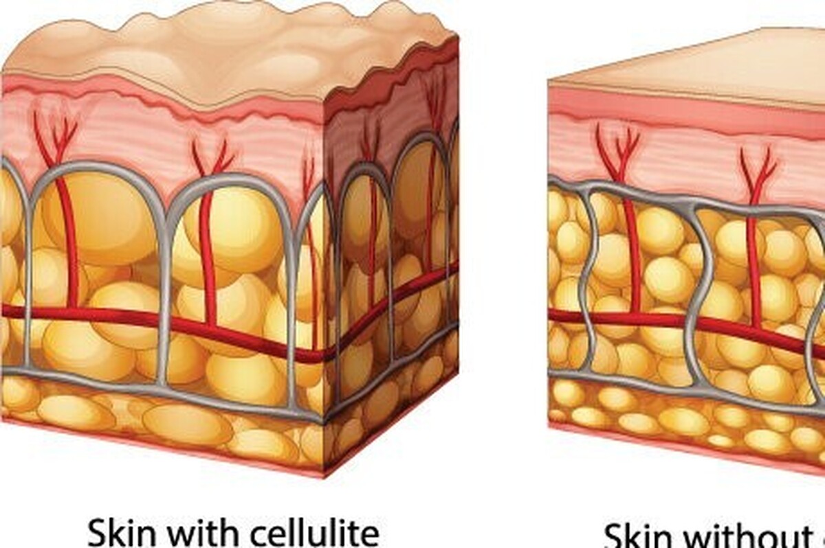 شیوع سلولیت به علت تفاوت‌های ساختاری بدن، در زنان بسیار رایج‌تر است