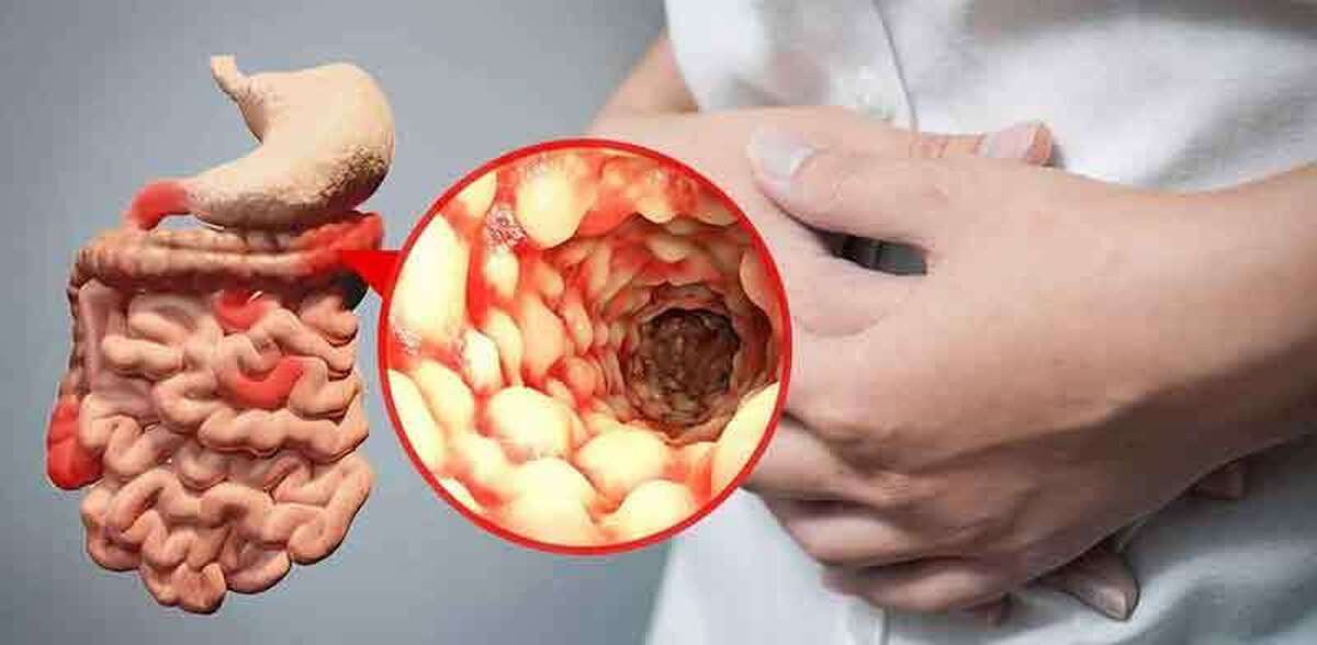 سفر‌های نوروزی و رفتن به مناطقی که شرایط بهداشتی متفاوتی دارند، خطر ابتلا به بیماری‌های گوارشی را بالا می‌برند؛ بنابراین برای پیشگیری از این نوع بیماری‌ها، بهتر است به یکسری مسائل بهداشتی توجه کنید.