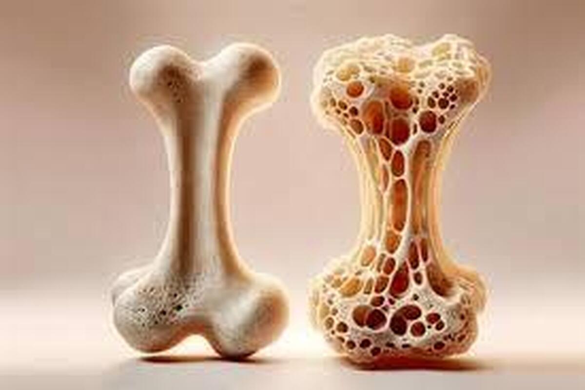 ابتلا به پوکی استخوان، تهدیدی برای یک‌سوم زنان کشور