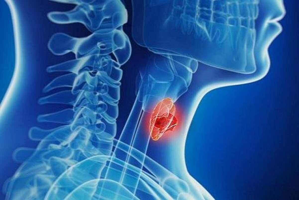 افزایش آمار تشخیص بدخیمی&zwnj;های تیروئیدی