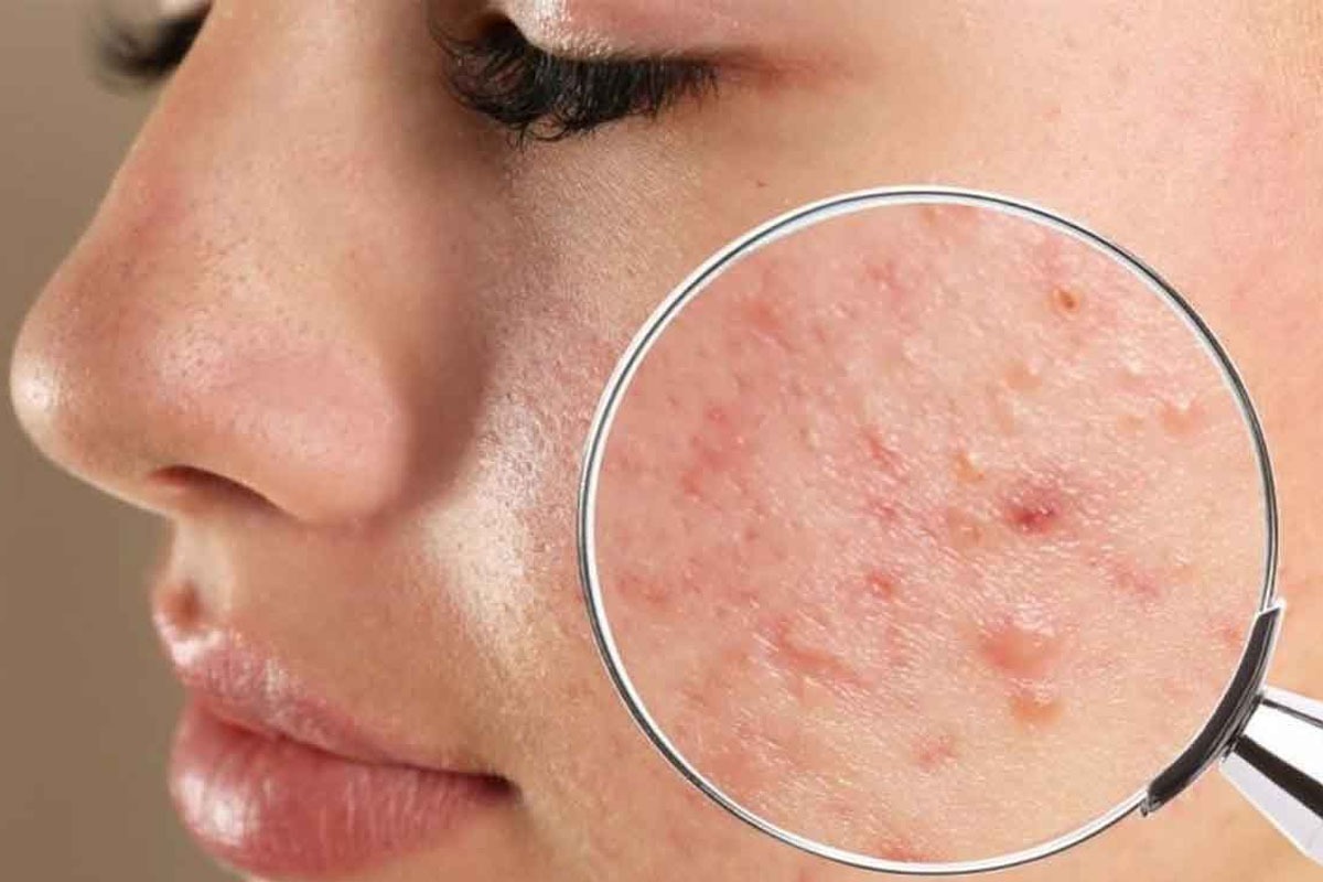 از ارتباط بین آکنه‌های پوستی با قند و شکر چه می‌دانید؟