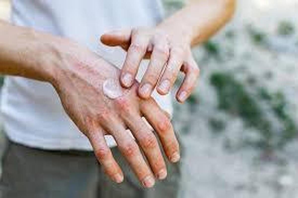 هوای سرد چه آسیب&zwnj;هایی به پوست می&zwnj;زند؟
