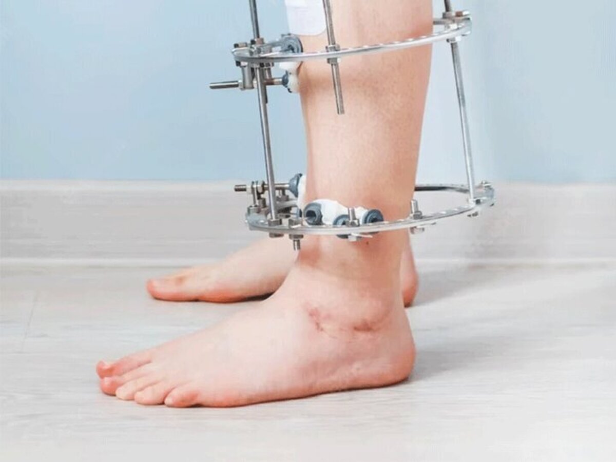 آیا جراحی افزایش قد اثربخش است؟
