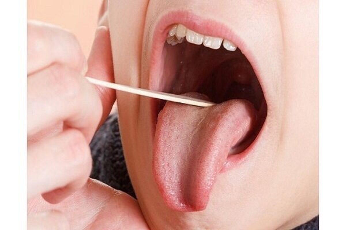 ایجاد شکاف یا تَرک روی زبان دلایل مختلی دارد و ممکن است ژنتیکی باشد یا نشانه‌ای از وجود یک بیماری در بدن شما باشد.