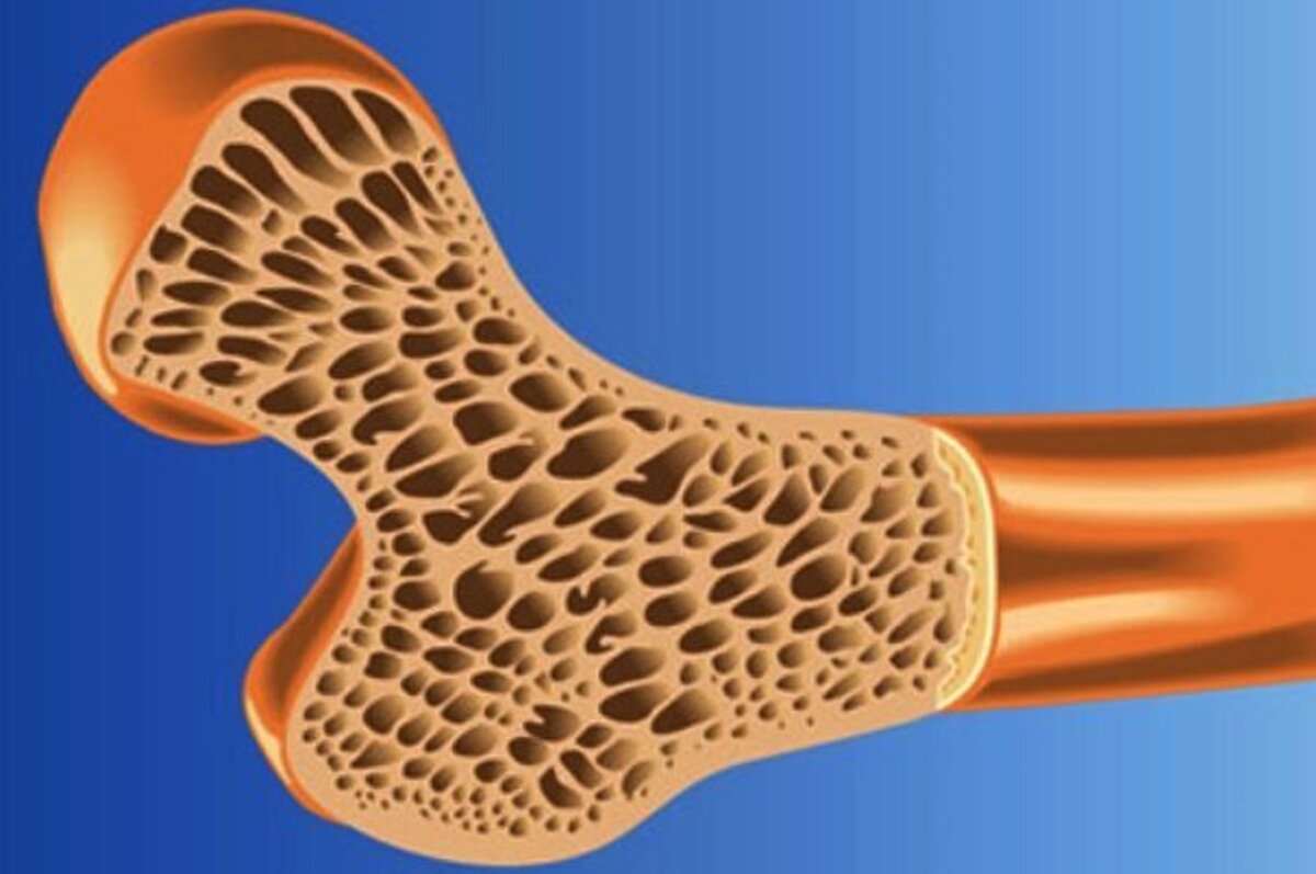 به گفته یک فوق تخصص روماتولوژی، براساس آخرین مطالعاتی که در خراسان شمالی انجام شده حدود ۲۹ درصد میانسالان خراسان شمالی پوکی استخوان دارند، گفت: همچنین، ۳۷ درصد از بانوان این استان به این بیماری مبتلا هستند.