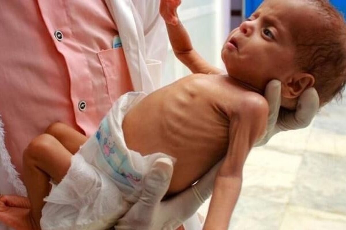 منابع پزشکی فلسطینی از سوءتغذیه شدید ۱۷ هزار کودک فلسطینی و شهادت یک کودک شیرخواره دیگر بر اثر سوء تغذیه در نوار غزه خبر دادند.