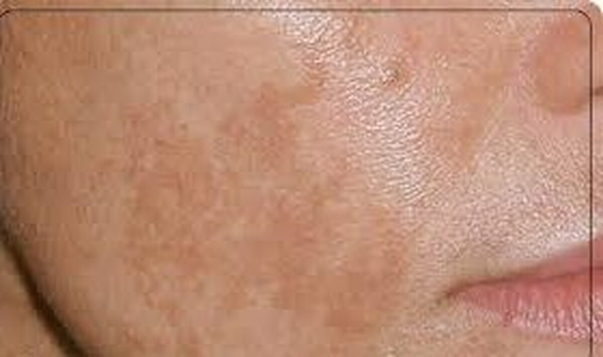 دلیل ایجاد لک های پوستی چیست؟