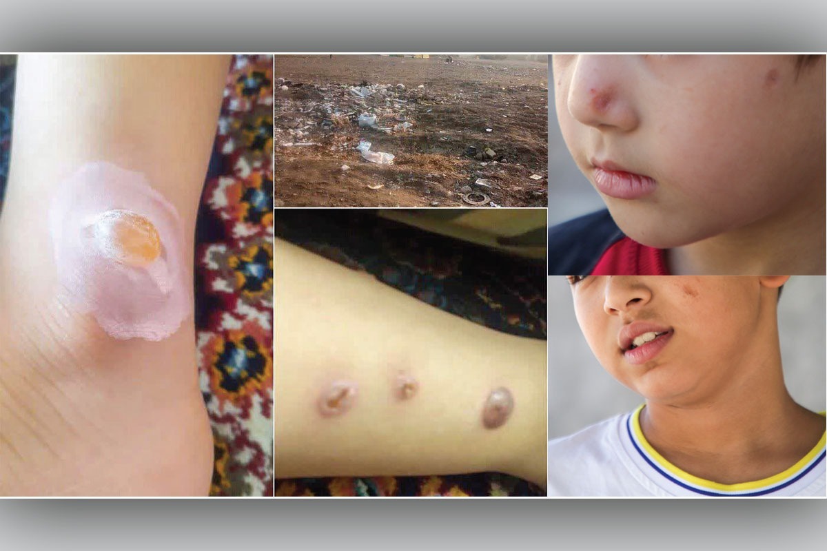 گلایه شهروندان برخی از محلات مشهد از بروز بیماری سالک و پاسخ علوم پزشکی | سالک را جدی بگیرید!