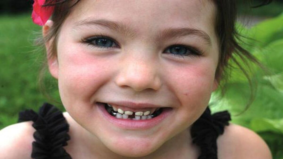 معاون بهداشت وزارت بهداشت، درمان و آموزش پزشکی با تأکید بر اینکه پوسیدگی دندان ربطی به جنسیت ندارد، گفت: ۷۰ درصد سالمندان بالای ۶۰ سال دندان ندارند.