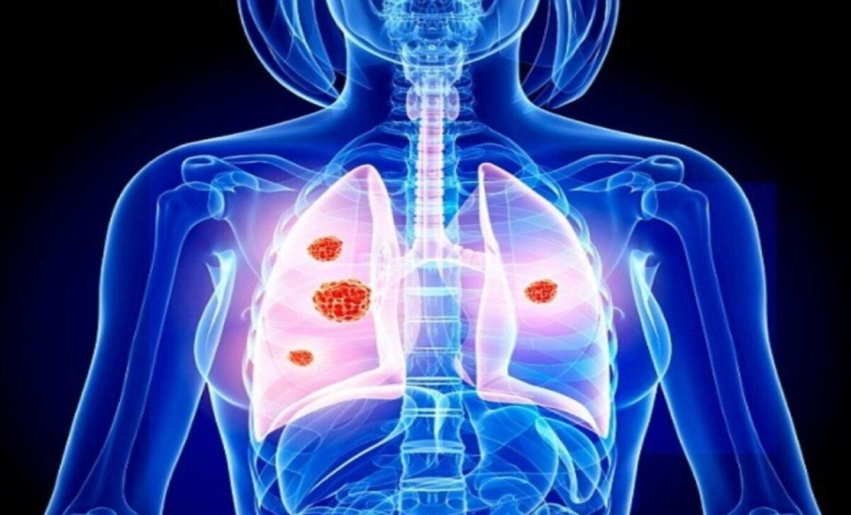 یک فوق‌تخصص ریه گفت: سیگار شایع‌ترین عامل بیماری‌های مزمن ریوی و سرطان ریه است و شروع مصرف در سنین پایین خطر ابتلا و مرگ ناشی از این بیماری‌ها را به‌طور قابل توجهی افزایش می‌دهد.