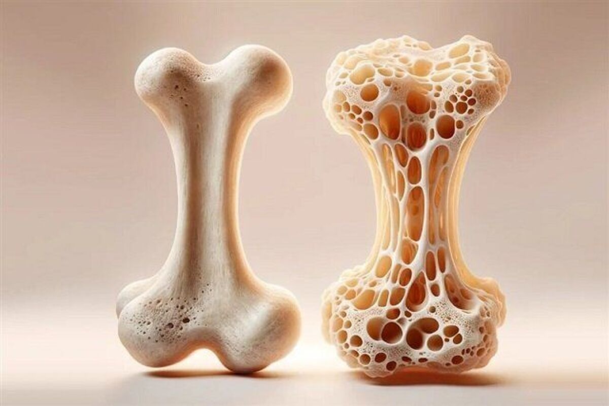 کاهش چشمگیر شکستگی استخوان در زنان با مصرف روزانه آلوی خشک