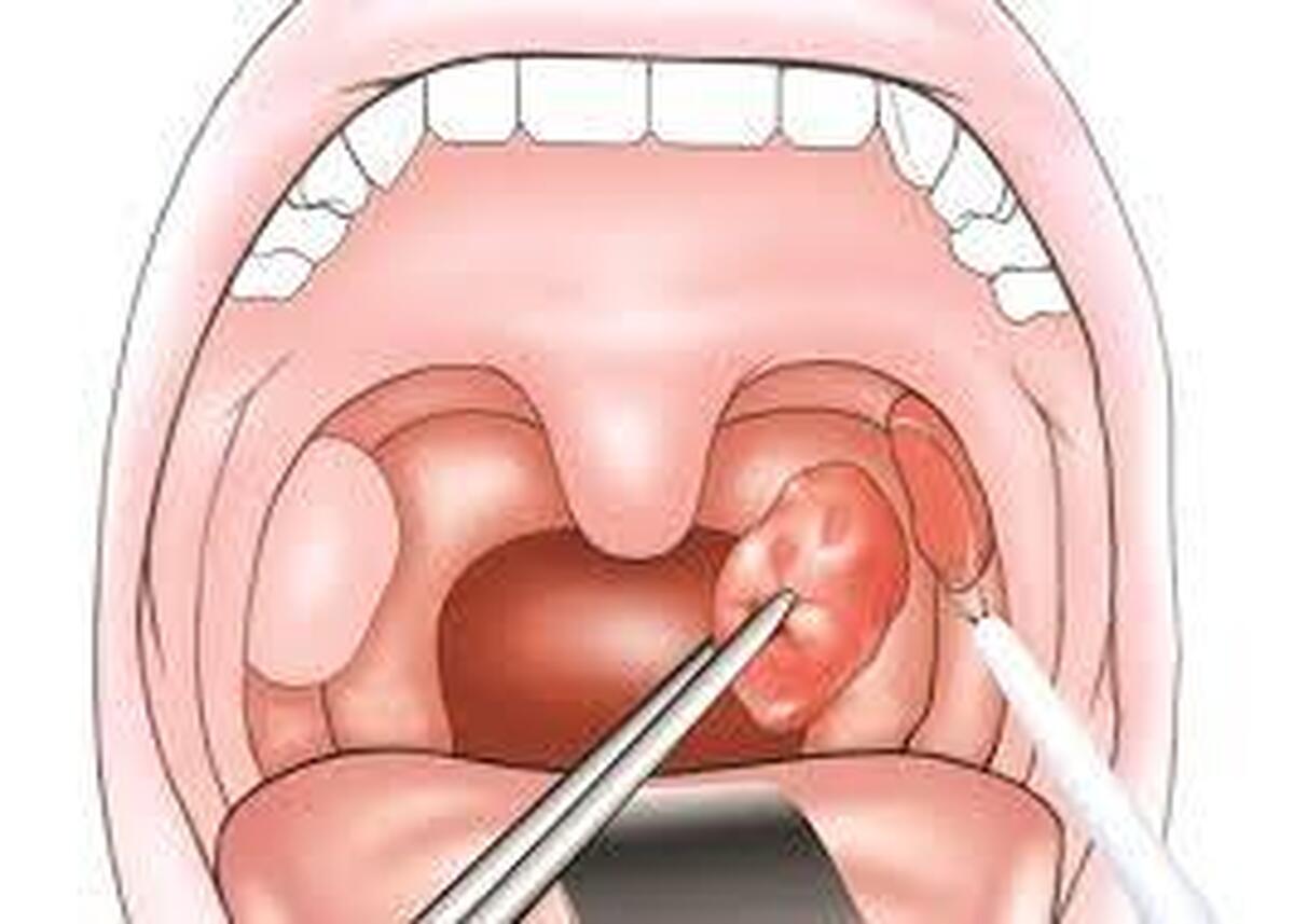 آیا کودک شما در خواب خر و پف می‌کند یا دچار تنفس دهانی شده است؟ ممکن است پای لوزه سوم یا آدنوئید در میان باشد.
