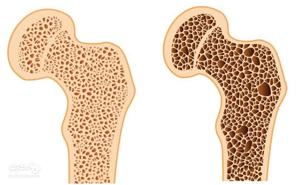 ضرورت انجام سالانه تست تراکم استخوان برای زنان بالای ۶۵ سال