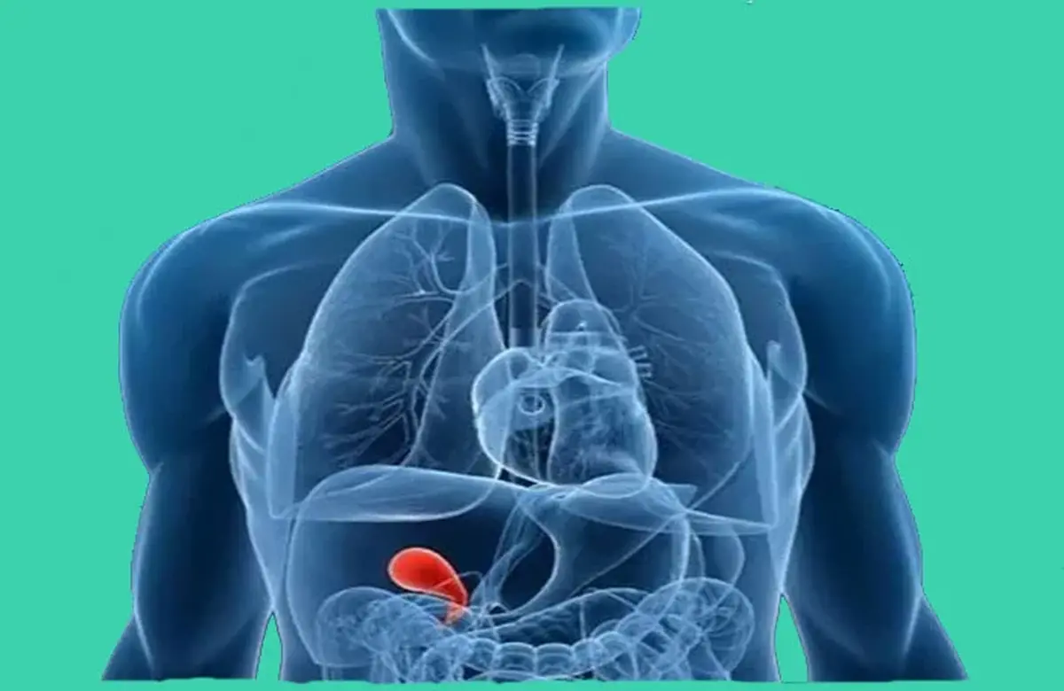 به گفته یک پزشک متخصص طب سنتی، سنگ کیسه صفرا به تعامل پیچیده بین عوامل ژنتیک، سبک زندگی و رژیم غذایی بستگی دارد. اضافه وزن، افزایش چربی‌ها و مقاومت به انسولین با افزایش بروز سنگ کیسه صفرا مرتبط است.